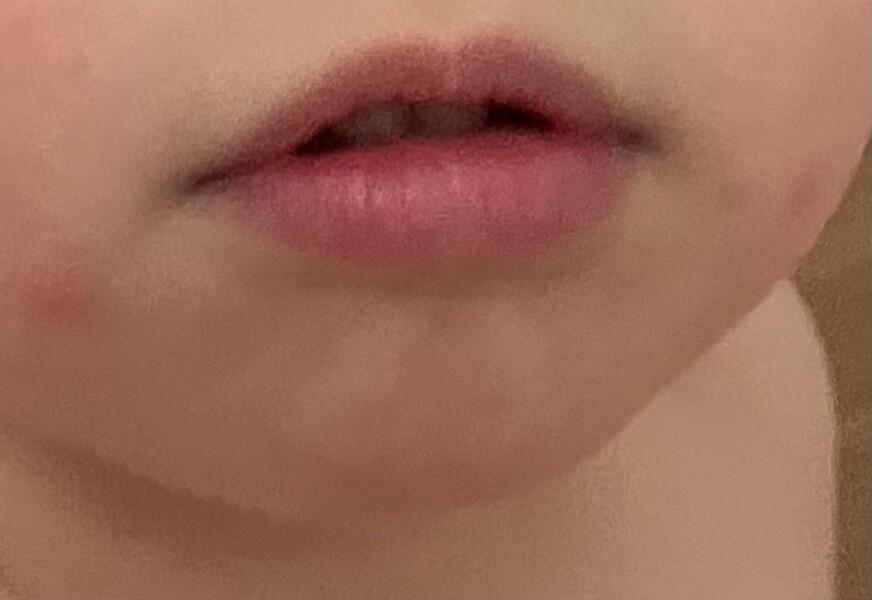 Is this chicken pox?