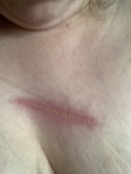 Posting for traffic - anyone know about burn healing?