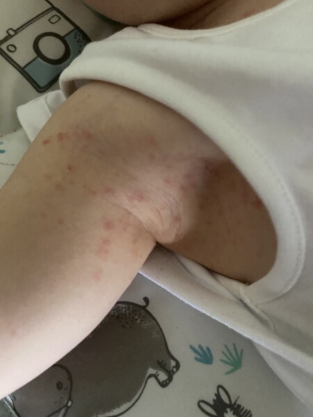 Spots on Daughter