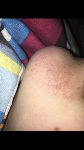 Pinpoint rash that looks like a bruise but dd swears she hasnt hurt it?