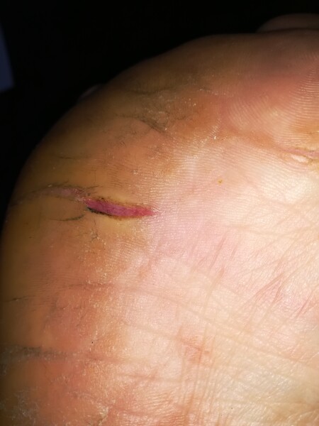 To use superglue on cracked feet..... 