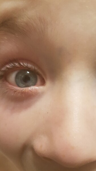 Any Opticians or Parents who might of seen in children can advise?