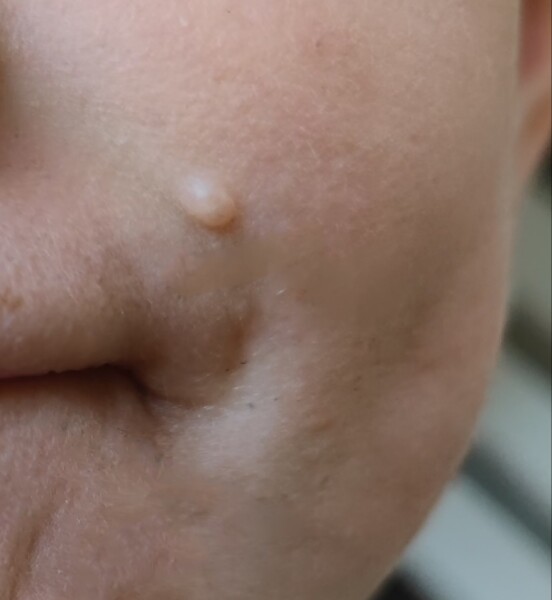 Skin Tag?