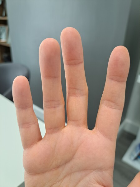 Why is my finger bent? *pic included*