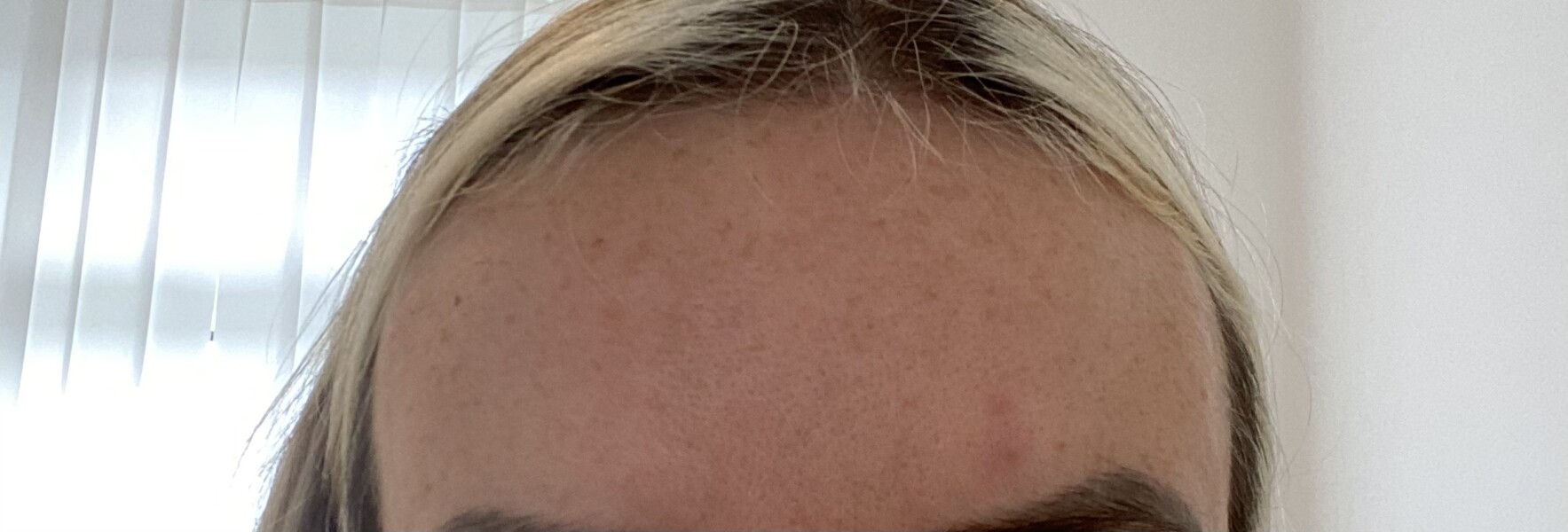 Has anyone successfully got rid of sunspots / pigmentation?