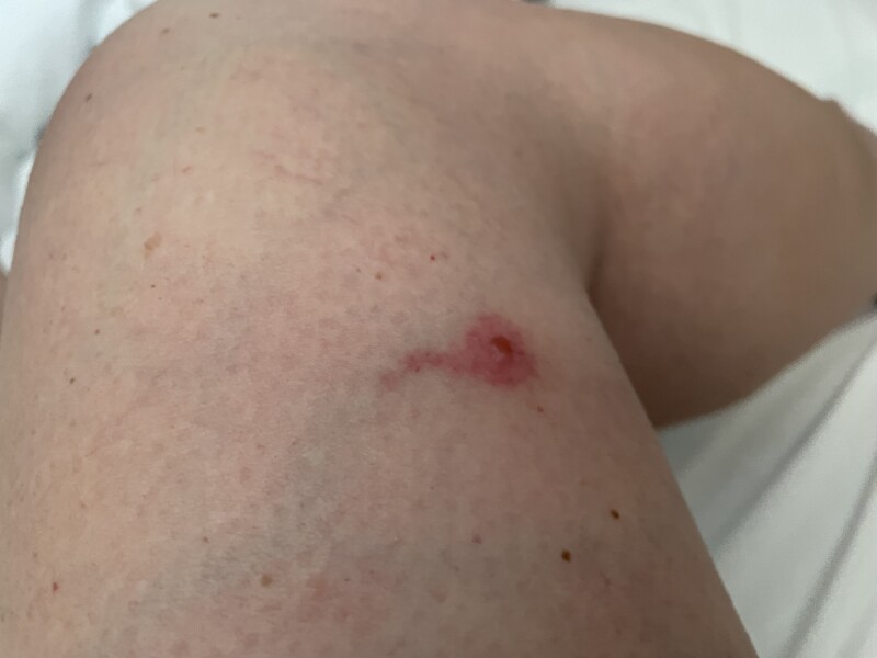 Weird bite, picture attached for fun