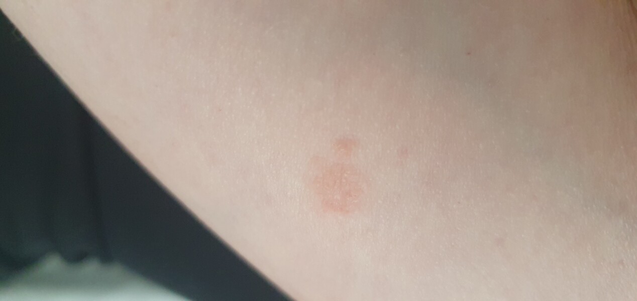 Ringworm?