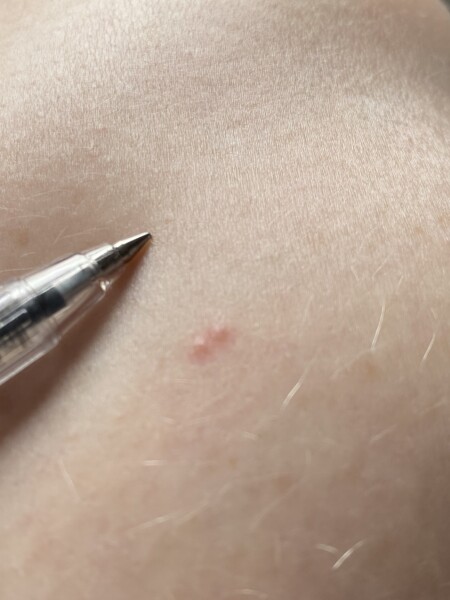What type of bite?