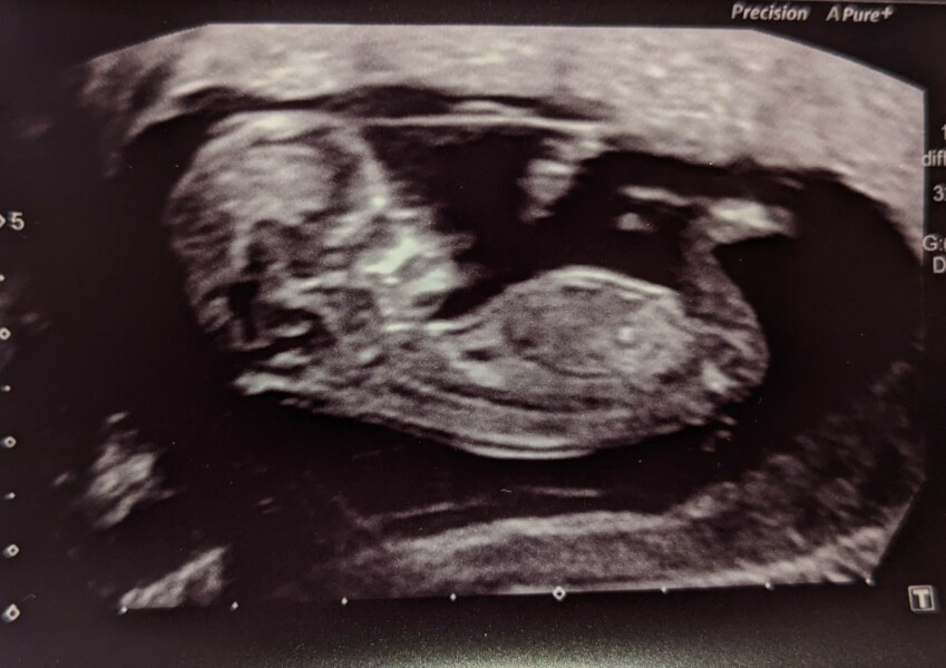 Navigating pregnancy after loss thread 3