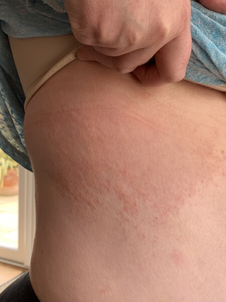 13 year old with severe hives