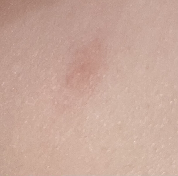 Is this chicken pox?