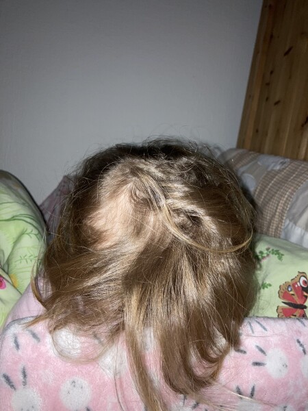 Toddler hair loss