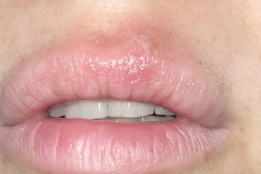 I've got my first cold sore ever and I'm about to get married