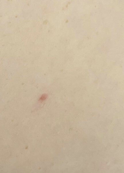 Worried about skin cancer :(