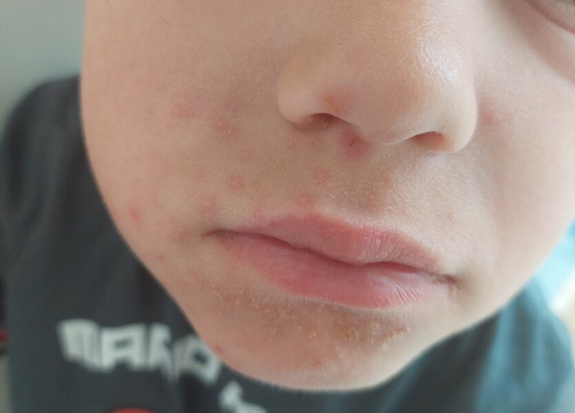 Does this sound like hand foot and mouth?