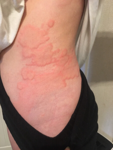 13 year old with severe hives