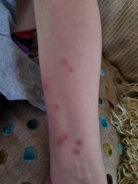 Is this chicken pox? 