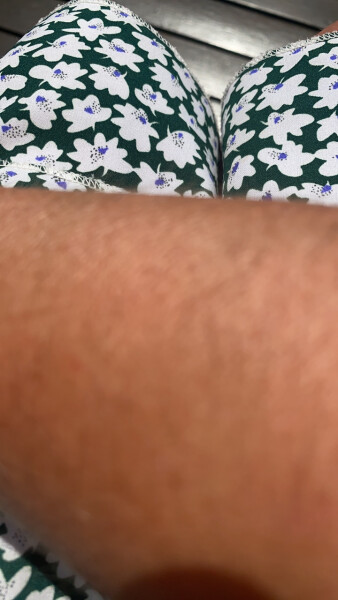 Think I have skin cancer 