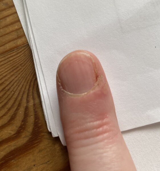 Cuticle that never fully heals - what is this? (Pics)