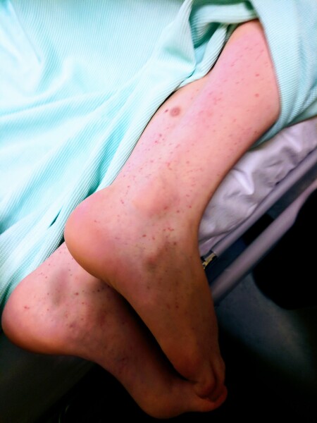 Pinpoint rash that looks like a bruise but dd swears she hasnt hurt it?