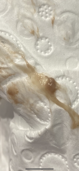 Pregnant , anxious , confused , early miscarriage 