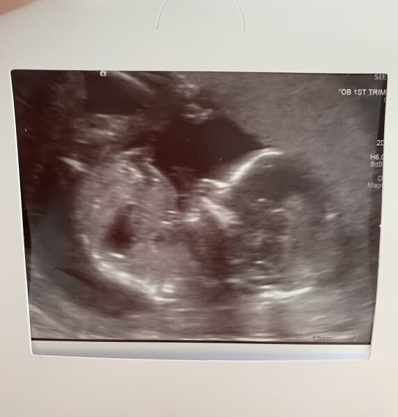 BFPs following IVF to take symptoms & scans