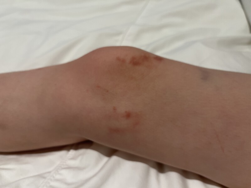 Any ideas about DDs weird rash? 