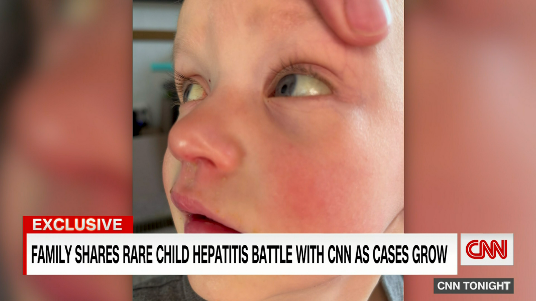 WHO: 650 children diagnosed with severe hepatitis since April