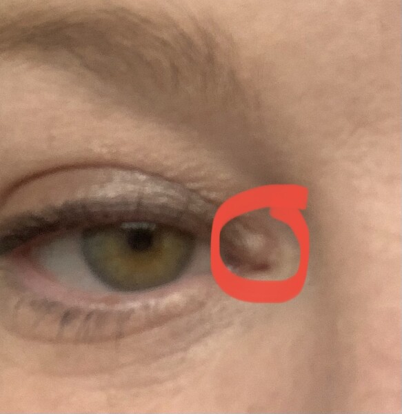 What's this on my eye?