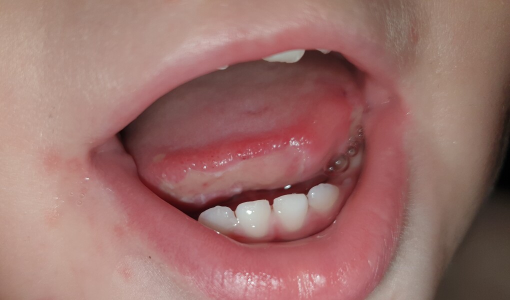 Toddler biting his tongue in his sleep - AIBU to be concerned?