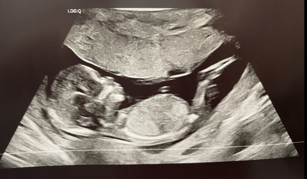 BFPs following IVF to take symptoms & scans