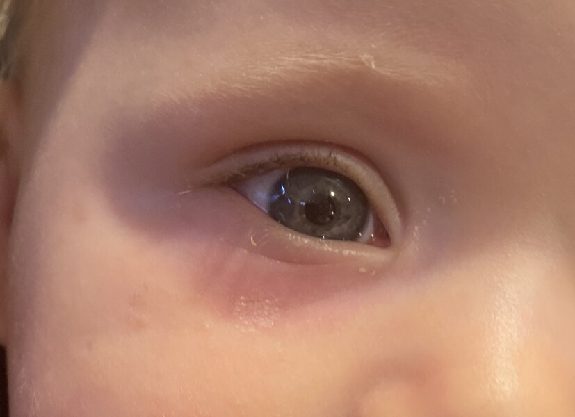 Puffy and purpler under eye?