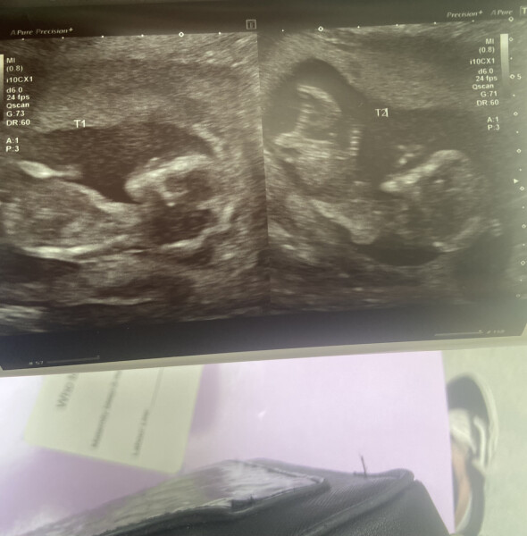 Preparing to TTC in 2022 part 4 -  where the BFPs keep on coming!