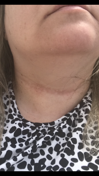 Line on neck 