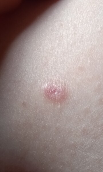 Carcinoma?