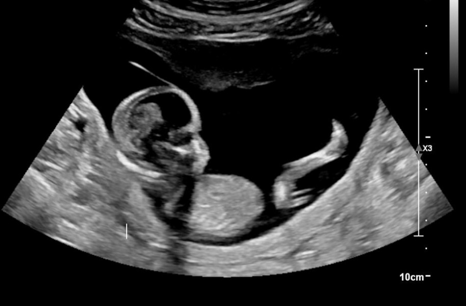 Help husband wants me to abort 