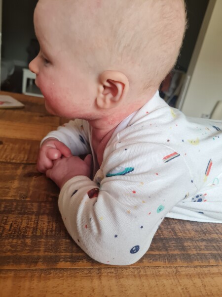 Baby's Skin is Red Raw