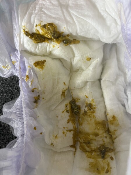 Diarrhea with mucus **senstive post**