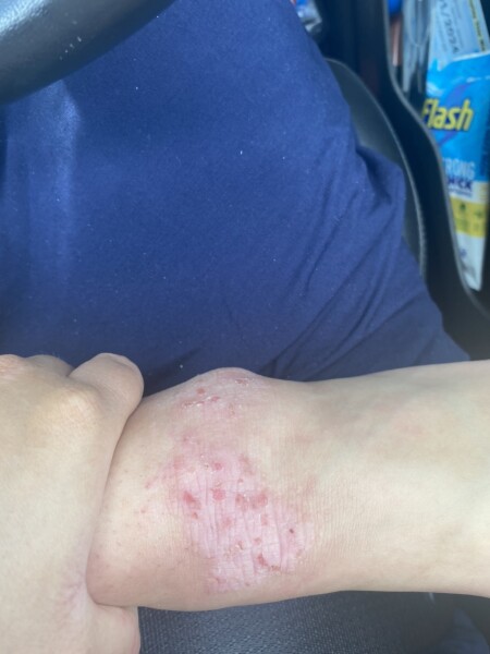 Anyone got any experience with Eczema?