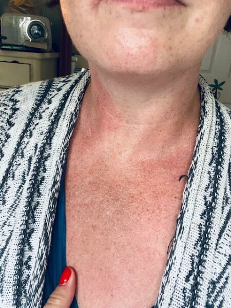 Skincare after being in the sun