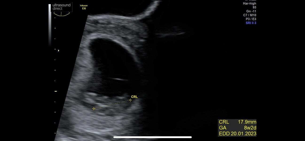 8 Week Scan Experiences please