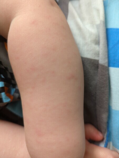 Quickly developing rash on toddler 