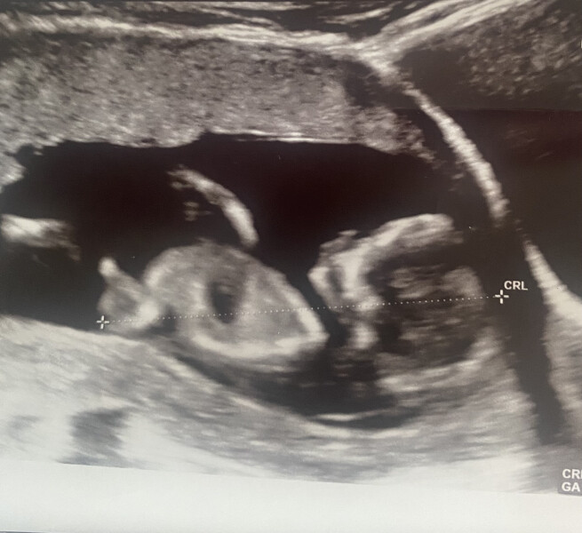 👶 Due November 2022 - part II 🎆