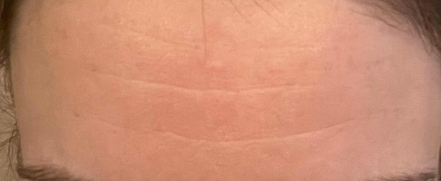 How old is my forehead?