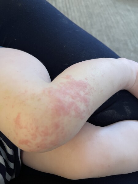 Unusual baby rash 