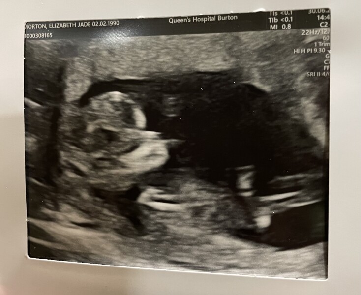 Navigating pregnancy after loss thread 3