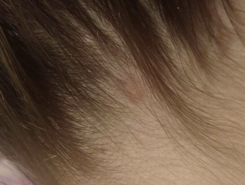Think I have skin cancer 