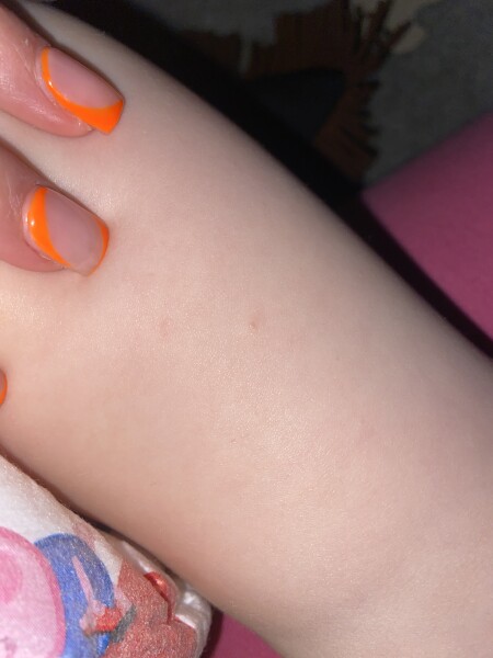 Chicken pox? 