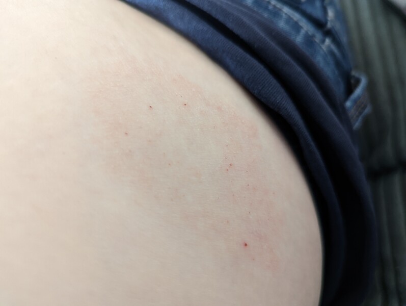 Rash 