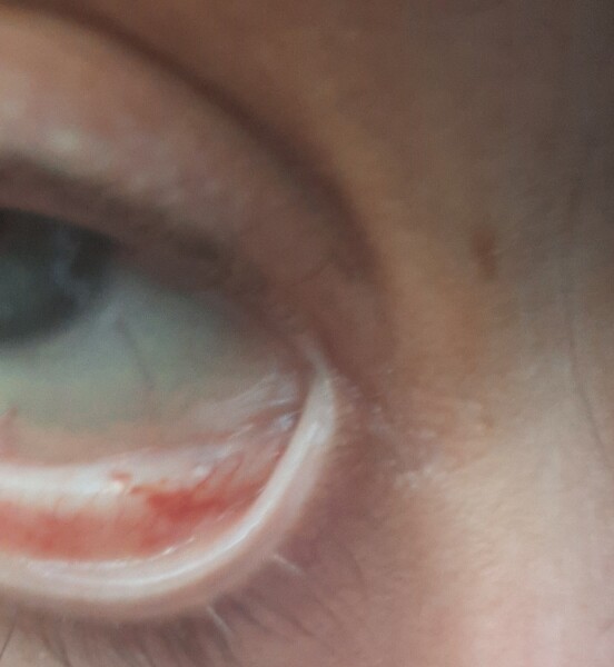 What's up with my eyes? (Pics)